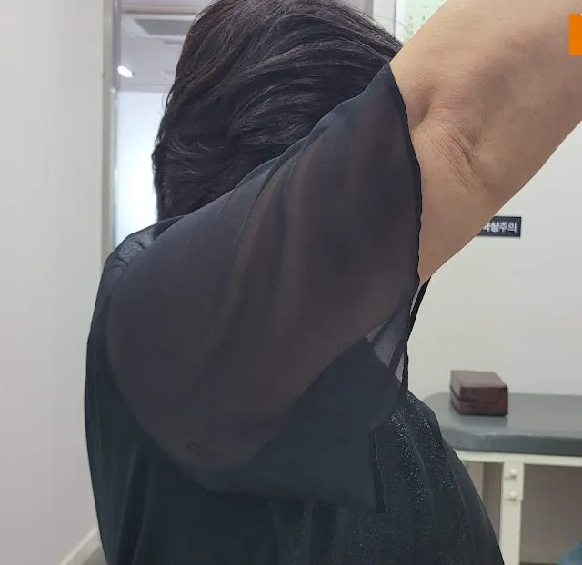 오십견으로 팔이 끝까지 올라가지 않는 모습. 한쪽 팔만 중간 높이에서 멈춰 있다.