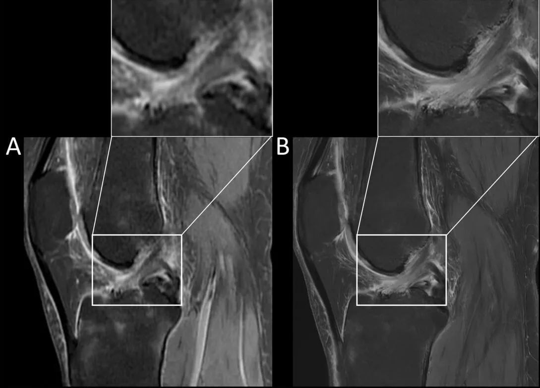 자기장 세기에 따른 MRI 영상 비교. A는 낮은 자기장, B는 3.0T로 촬영한 인대 부위 영상이며 섬유 결의 선명도 차이가 뚜렷하다.
