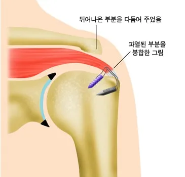 회전근개 봉합술 후 모식도. 뼈에서 튀어나온 부분을 다듬고, 파열된 힘줄을 앵커와 봉합사로 원래 자리에 봉합했다.