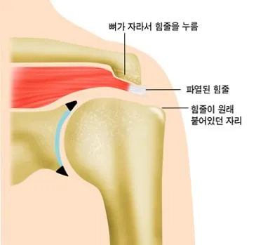 회전근개파열 모식도. 견봉 아래 자란 뼈가 힘줄을 누르고, 힘줄이 원래 붙어 있던 자리에서 떨어져 파열되어 있다.