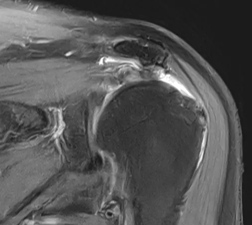 회전근개파열 MRI 소견. 끊어진 힘줄이 원래 붙어 있던 자리에서 안쪽으로 말려 들어가 있다.